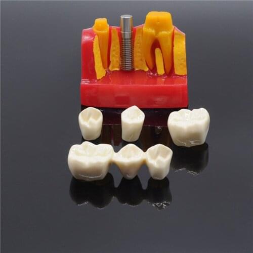 Dental Clinic Implant Analysis Crown Bridge Demonstration Teeth Model For Lab Supplies