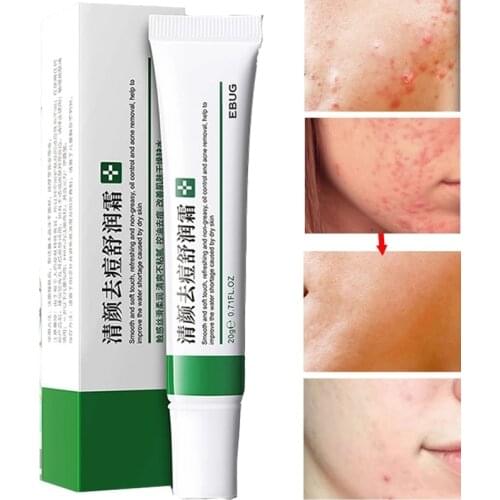 20g Effective Whitening Freckle Cream Remove Melasma Dark Spots Effective Acne Removal Cream Acne Treatment Fade Acne Spots Oil