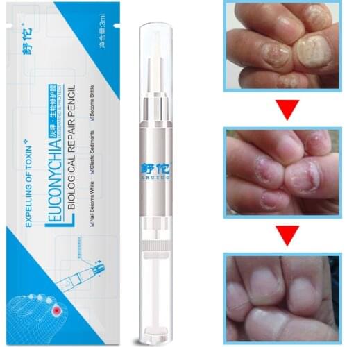 Leuconychia Degerming & Protect Biological Repair Pencil Nail Toes Fungal Treatment Pen Liquid Anti Nail Toenail Fungus