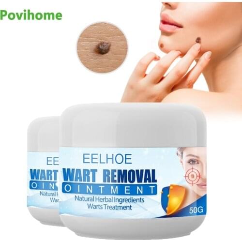 30&50ml Wart Corn Removal Cream Skin Tag Remover Chinese Medicine Body Genital Warts Treatment Medical Skin Skin Care