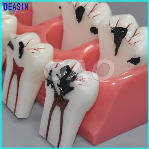 Caries jewelry decomposition model of teaching evolution model Dental Teaching Study Model