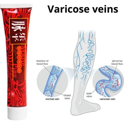 5pcs RuiTong Varicose Vene Crema trattamento Professionale Vasculite Flebiti Spider Vene Dolore Varici Angiitis Gesso Medica