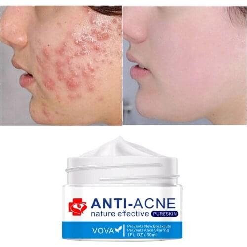 Natural Effective Anti Acne Cream Acne Mark Repair Gel Moisturizing Lightening Pigment Acne Skin Care Repair Acne Pit Skin Care