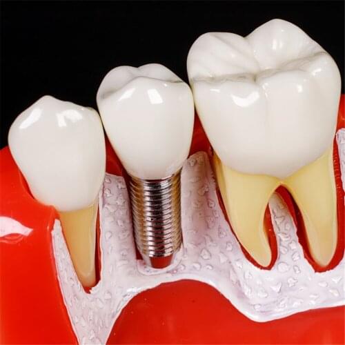 4 Times Teeth Model Dental Implant Analysis Crown Bridge Demonstration Dental Teeth Model Dentist Study Implant Model M2017R