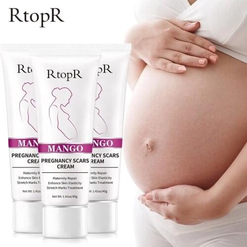 Mango Stretch Marks Treatment Maternity Repair Anti-Aging Anti Winkles Firming Body Creams Remove Pregnancy Scars Acne Cream