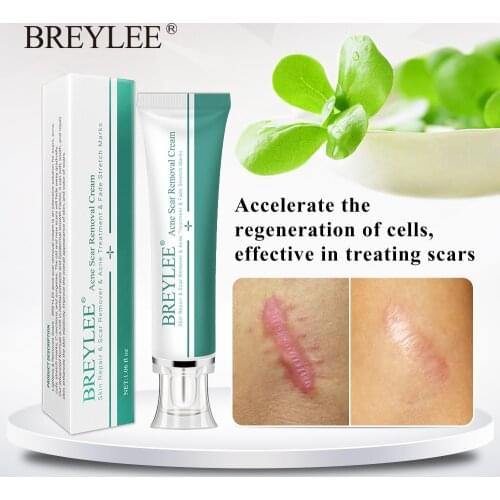 BREYLEE Acne Scar Removal Cream Skin Remove Stretch Marks Repair Skin Care Scar Acne Treatment Whitening Cream Face Cream 30g