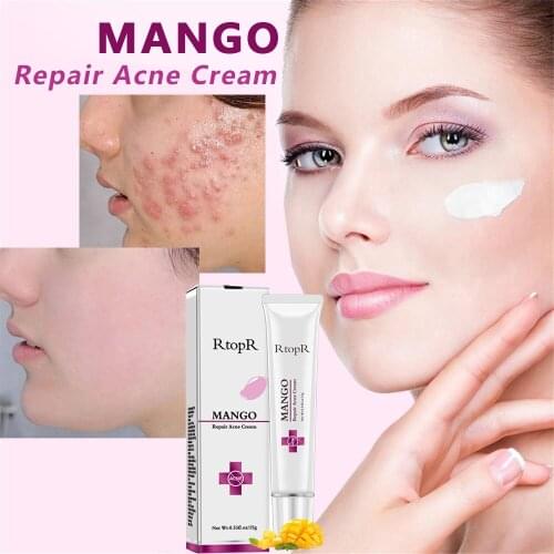 RtopR 15g Natural Mango Extract Face Acne Remover Cream Acne Scar Treatment Effectively Remove Pimple Scar Anti Acne Cream TSLM1