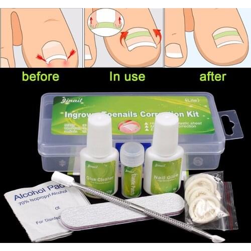 Lite Mildly 12pcs kit Ingrown Toenail Straightening Clip Curved BS Brace Toenails Thick Paronychia Correction Tool