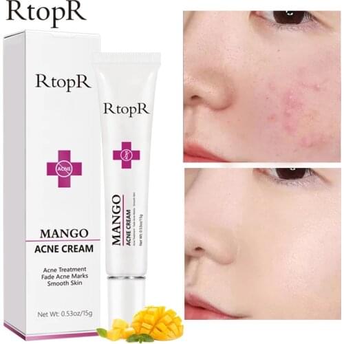 Mango Repair Acne Cream Anti Acne Spots Acne Treatment Scar Blackhead Cream Shrink Pores Whitening Moisturizing Face Skin Care