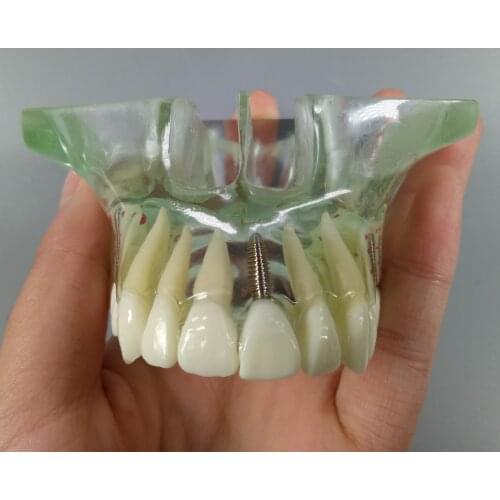 1Pis-20Pis Dental Implant Anterior Front Teeth Molar Implants Study Model Maxillary Sinus Upper Jaw Restoration 1 Piece
