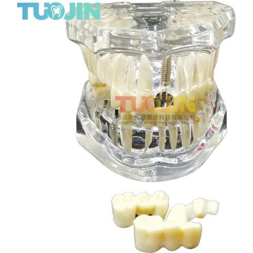 1PCS Dental Disease Teaching Teeth Model Implant False Tooth Transparent Pathological Repair Training Study Demonstration Model