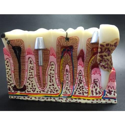 Dental teeth common pathologies model teaching model ,Tooth Dentist for Medical Science Teaching