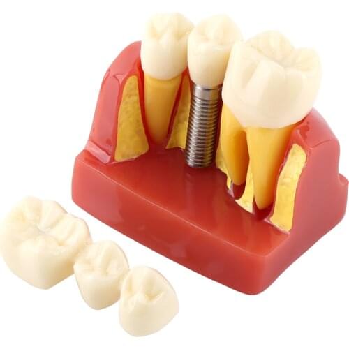 1pc Resin Dental Demonstration Tooth Model Implant Analysis Crown Bridge for Dentist