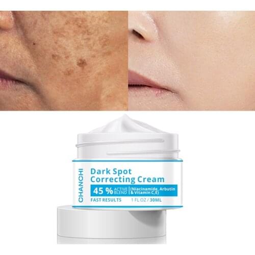 Effective Whitening Freckle Cream Remove Melasma Acne Spot Pigment Melanin Dark Spots Pigmentation Moisturizing Gel Skin Care