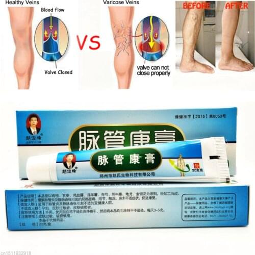 1PC Varicose Veins Treatment Cream Vasculitis Relief Phlebitis Angiitis Inflammation Blood Vessel Legs Varicose Veins Ointment
