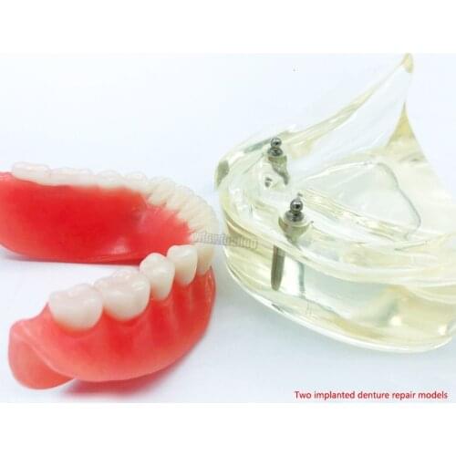 Removable mandibular denture model with 2 implants and 2 nails for repairing doctor and patient