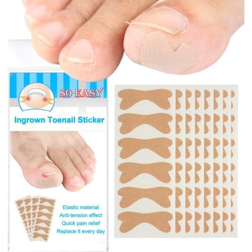30pcs Toenail Patch Ingrown Toenail Correction Pedicure Tool Toe Inlay Nail Corrector Nail Patch Correction Stickers