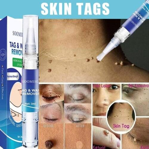 Genital Wart Treatment Papillomas Removal of Warts Liquid From Skin Tags Removing Against Moles Remover Wart Removal liuld