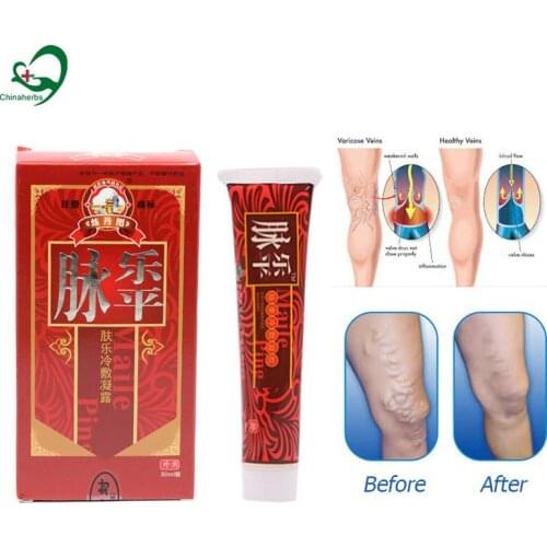 2 Pcs Varicose Treatment Cream Limb Swelling Cramps Vasculitis Phlebitis Spider Veins Pain Plaster Angiitis Ointment