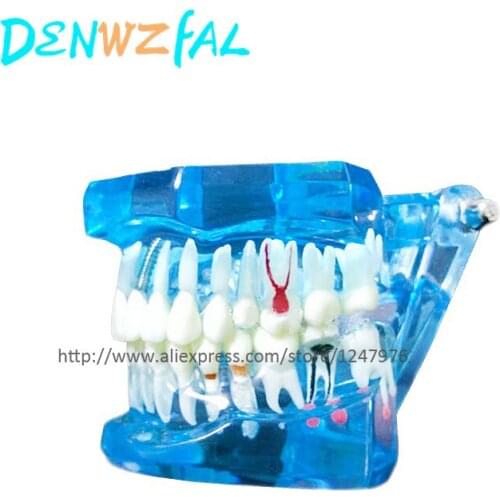 Oral pathology model doctor patient communication model comprehensive pathology model removable dental implant model