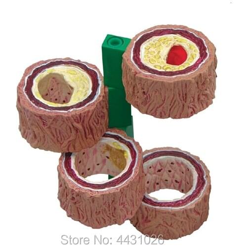 ENOVO Atherosclerosis model thrombosis model cardiovascular model endoscience