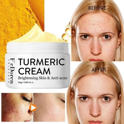Turmeric Face Cream Repair Acnes Scar Dark Spot Treatment Moisturizer Whitening Lightening Against Acne Skin Care 30g