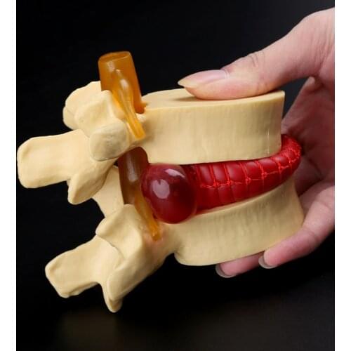 Medical props model Free postage Anatomical Spine Lumbar Disc Herniation Anatomy Medical Teaching Tool