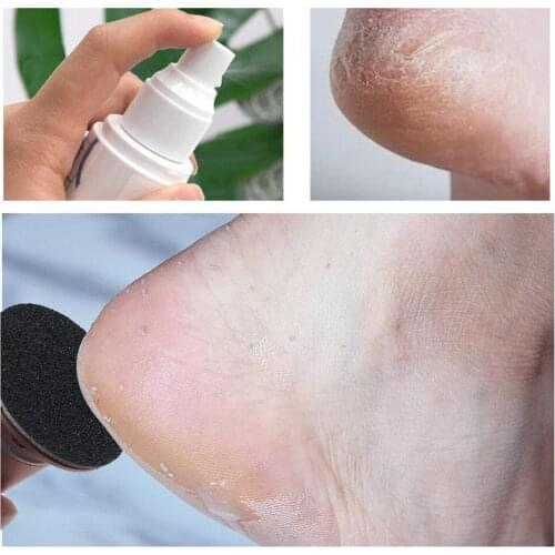 Foot Callus Softener Spray 80ml Works with Foot Scrubber File Pumice Stone