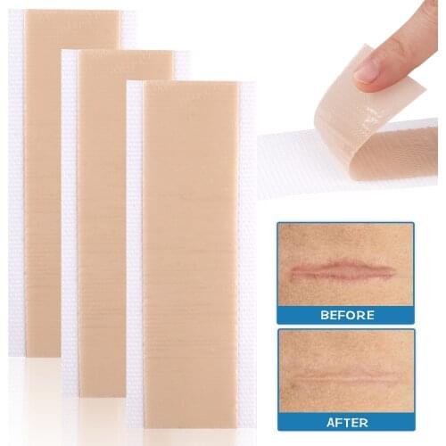 4x15cm Scar Patches Remove Silicone Gel Sheet Treatment Patch Ear Correctors Burn Wounds Efficient Surgery Scar Tape Skin Repair