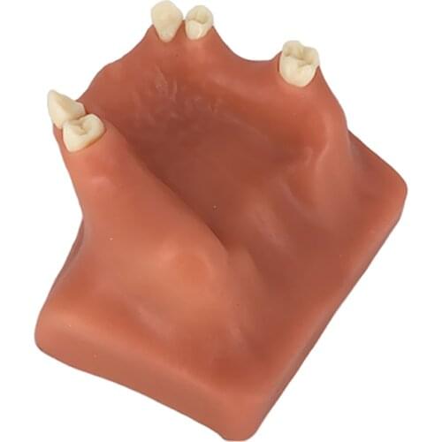 Upper Jaw Sinus Lift Implants Restoration Tooth Practice Model
