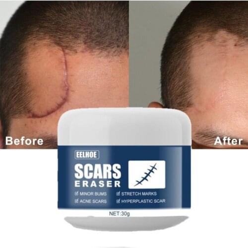 Advanced Treatment For Face & Body Old & New Scars From Cuts,Stretch Marks,C-Sections & Surgeries Skin Care Scar Removal Cream