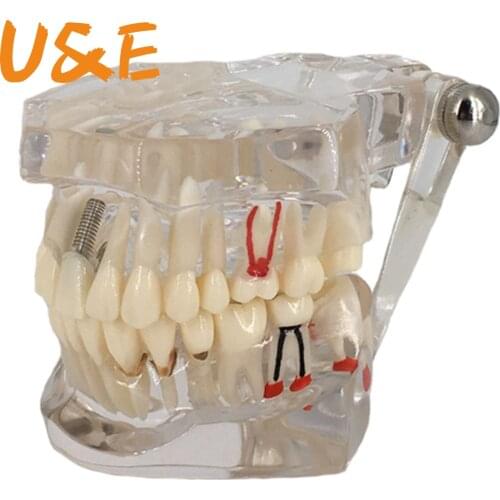 Transparent Disease Teeth Model Dental Implant Teeth Model Dentist Dental Student Learning, Teaching, Research Communication