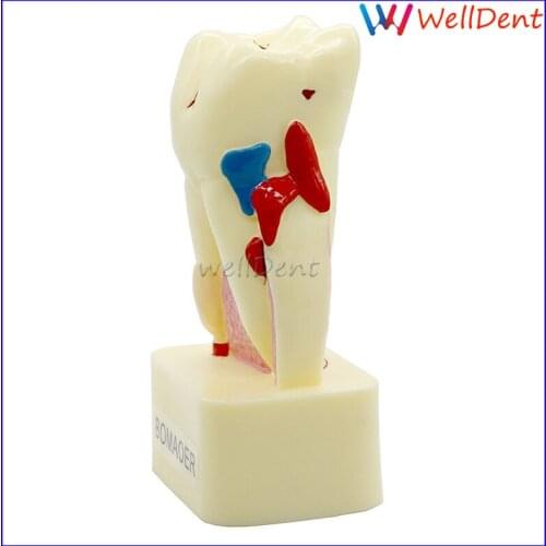 Dental Teeth Model Tooth Model Dental Caries Calculus Pulp Stones Occlusal Tooth Wear Pathology Teeth Model