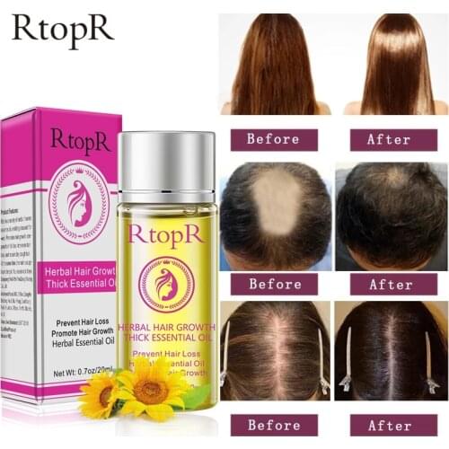 RtopR Herbal Hair Growth Treatment Essential Oil Anti-hair loss Health Care Beauty Essence 20ml
