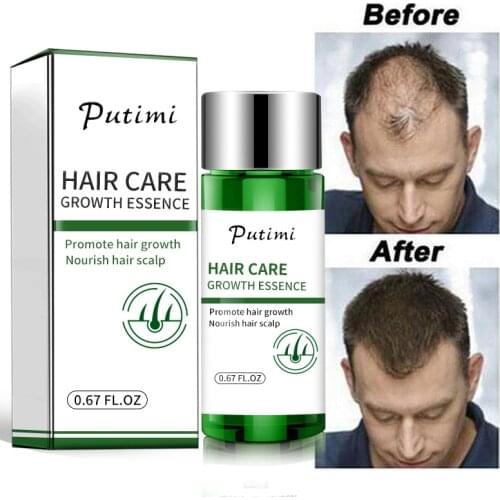 Ginger Hair Growth Essential Oils Promote Hair Regrowth Essence Prevent Baldness Hair Loss Serum Repair Damaged for Women Men