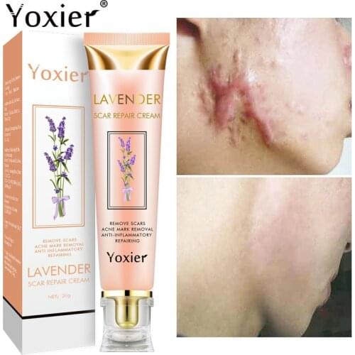 20g Remover Acne Scar Stretch Cream Marks Repair Acne Spots Acne Treatment Face Cream Blackhead Skin Care Whitening Cream
