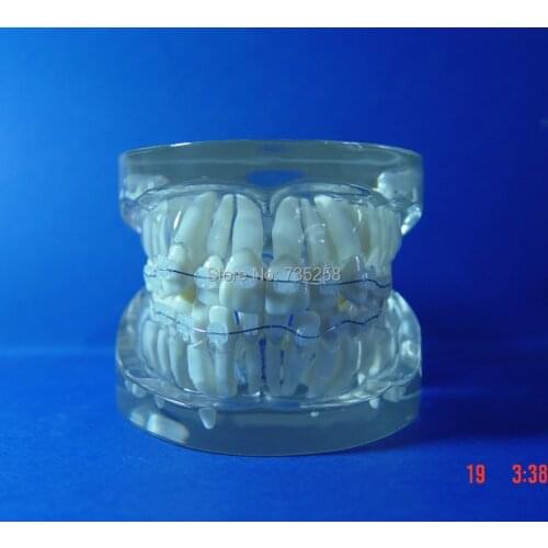 Teeth Orthodontic Model,Ceramic Braces Wrong jaw Demonstration Model,Orthodontics Practice Model