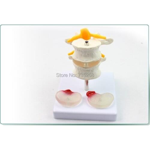 Human Lumbar Disease Model,Intervertebral Disc Model,Lumbar Spine Model,Lumbar Spinal Pathology Model