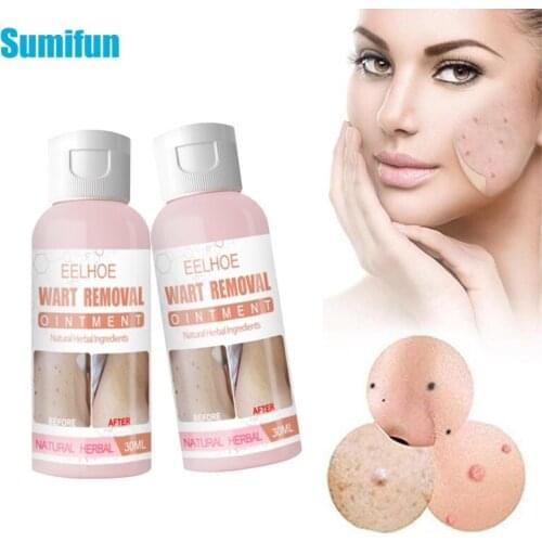 30ml Skin Tag Remover Genital Wart Treatment Instant Removal Mole&Papillomas Foot Corn Repair Tool Natural Bacteriostatic Liquid