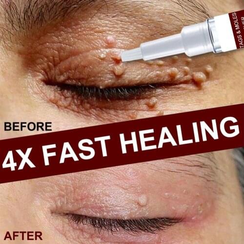 2pcs Skin Wart Removal Liquid 3ml Quickly Remove Male Female Skin Tag Remove Pen Moles Remover