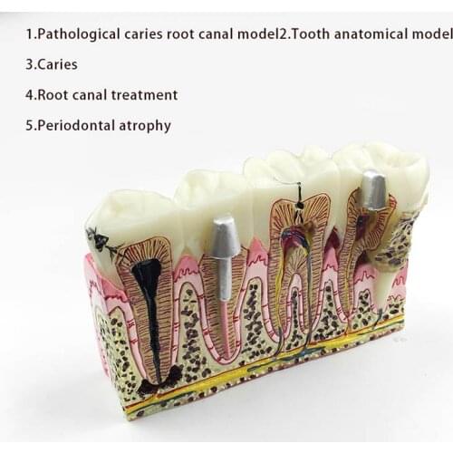 Dental Anatomy of Dental Caries Plastic Teeth Model Demonstration Communication