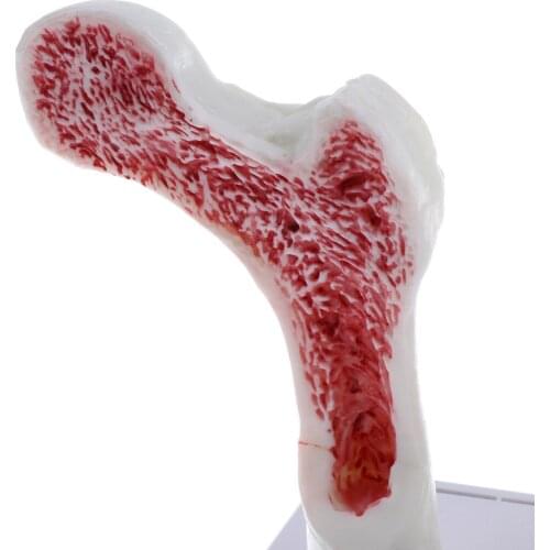 1:1 Human Osteoporosis Skeleton Model, Pathology Model, Human Anatomical Models, Lab Equipment & Ornament
