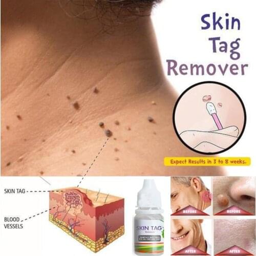 Skin Tag Remover 12 hours Tu kill Medical Tu kill Remover Skin Tag Mole & Genital Wart Remover Foot Corn Removal 10ml