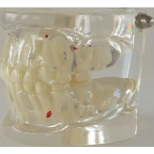 Clear Mixed Age with Pathology Oral Tooth milk permanent teeth alternating Dental Teeth Model