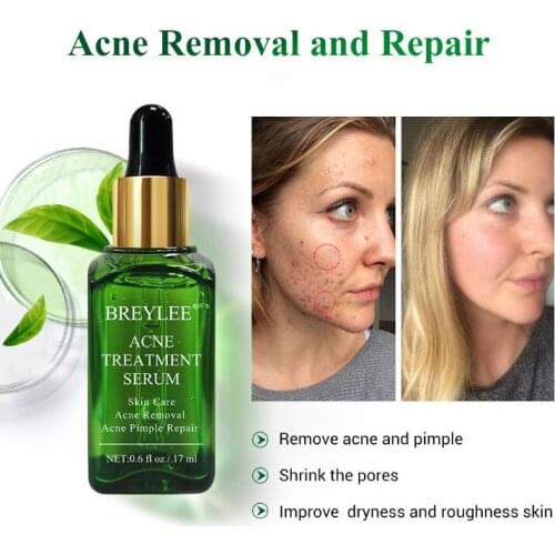 BREYLEE 40ml Acne Treatment Serum Face Facial Essence Anti Acne Scar Removal Cream Skin Care Whitening Pimple Remover For Acne