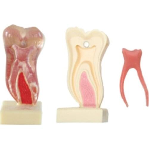 6 Times Anatomic Profile Model of Mandibular Molar for Teeth Studay and Education