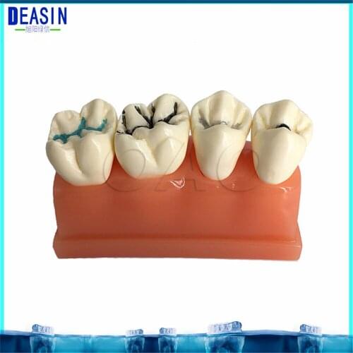 Caries jewelry decomposition model of teaching evolution model Dental Teaching Study Model