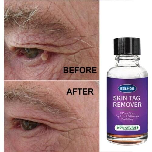 10/20/30/50ml Mole Skin Tag Removal Solution Painless Mole Skin Dark Spot Removal Face Wart Tag Removal Skin Care Tools