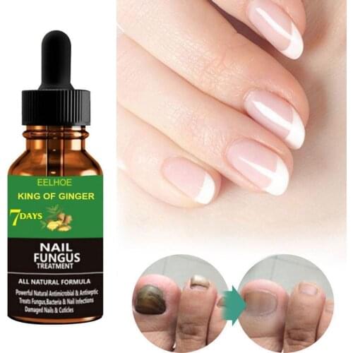 10-50ml Ginger Foot Antifungal Nail Essence Nails Care Repair Nail Fungal Treatment Anti-Fungus Onychomycosis Removal Liquid Use
