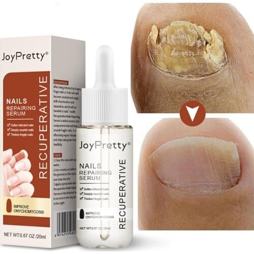 Nail Fungus Treatment Serum Natural Safe Nail Repairing Serum for Healthy Glossy Nails for Fingernails Toenails For nails